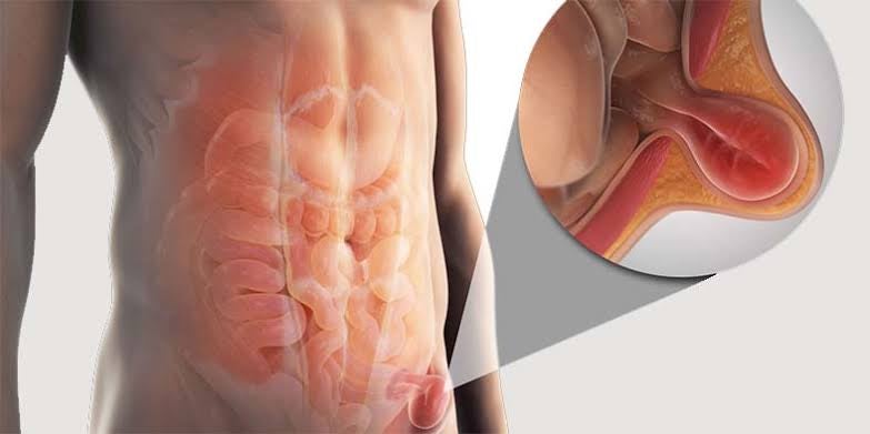 Hérnia Incisional: Como Ela Surge Após uma Cirurgia? | Dr. Vitor Neves Explica